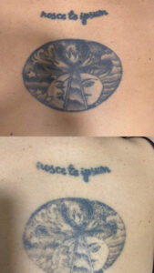 Equilaser Tattoo Remove – Eliminación De Tatuajes