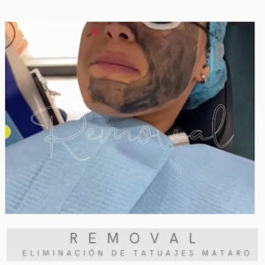 Removal Eliminación De Tatuajes Mataró